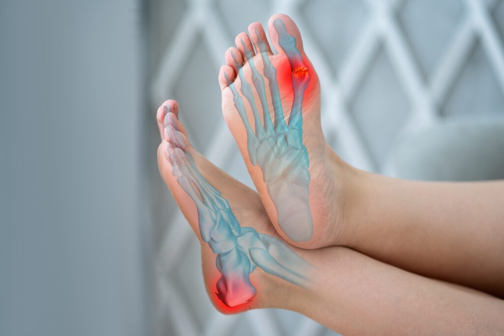 joint,diseases,,hallux,valgus,,plantar,fasciitis,,heel,spur,,woman's,leg